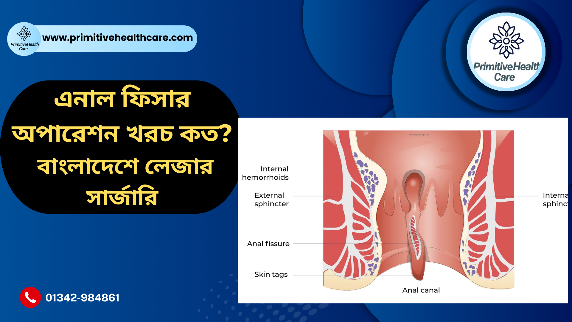 Anal Fissure Operation Cost Bangladesh